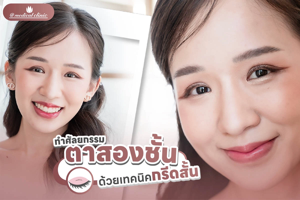 กรีดสั้น