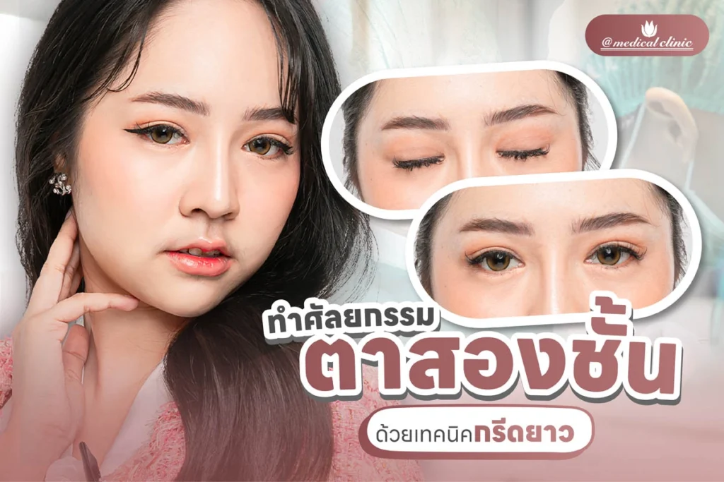 กรีดยาว