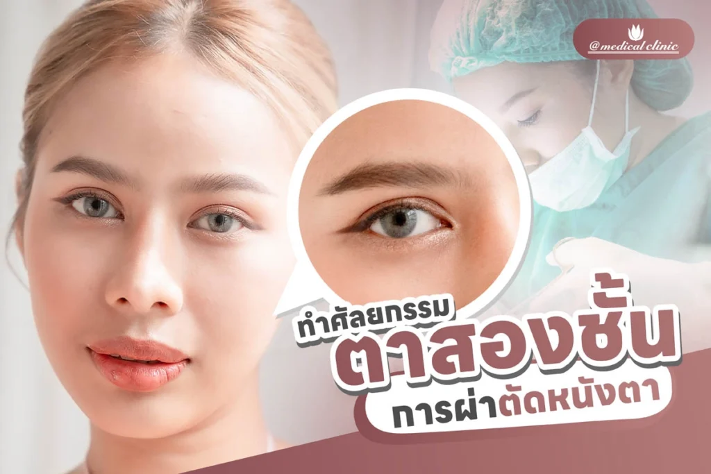 ตัดหนังตา
