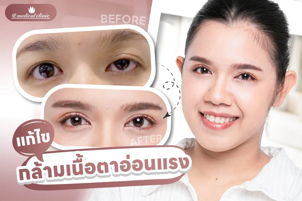 แก้ไขกล้ามเนื้อตาอ่อนแรง